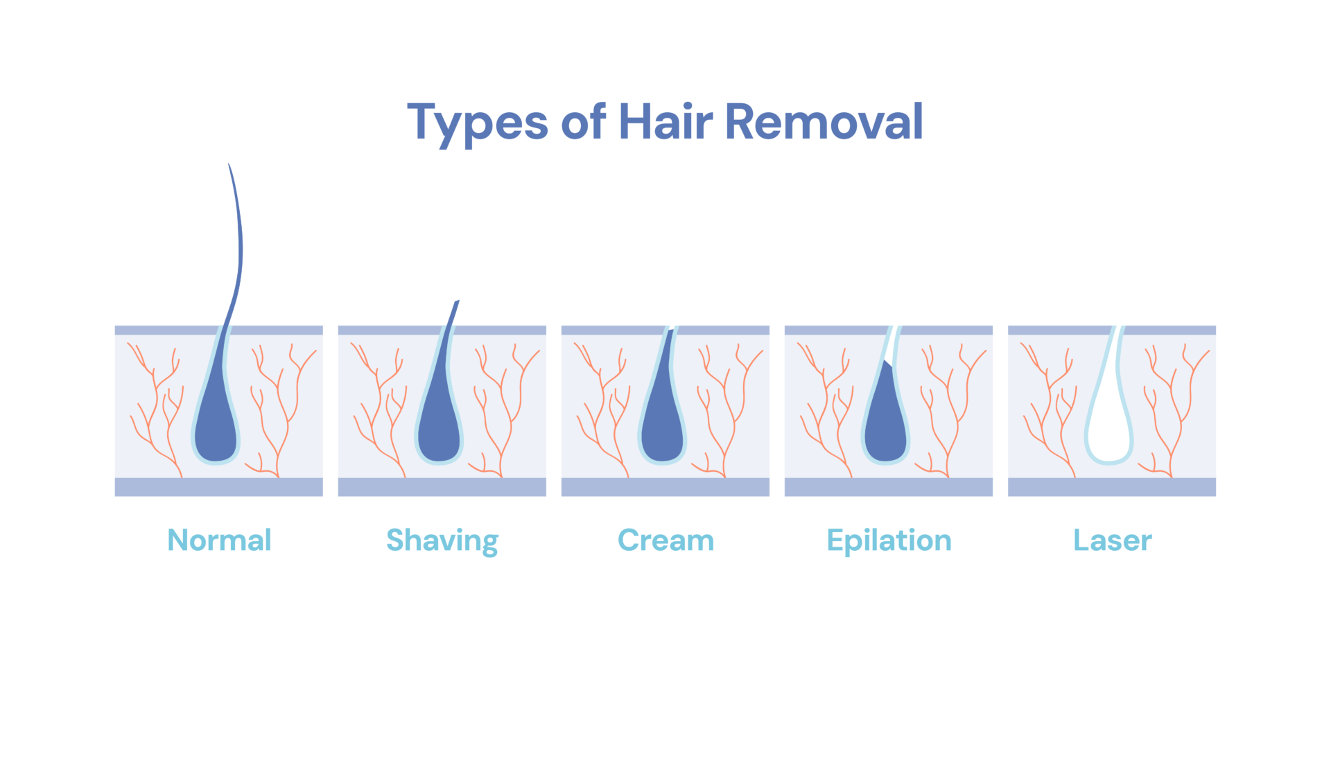 types of hair removal. normal. shaving. cream. epilation, laser