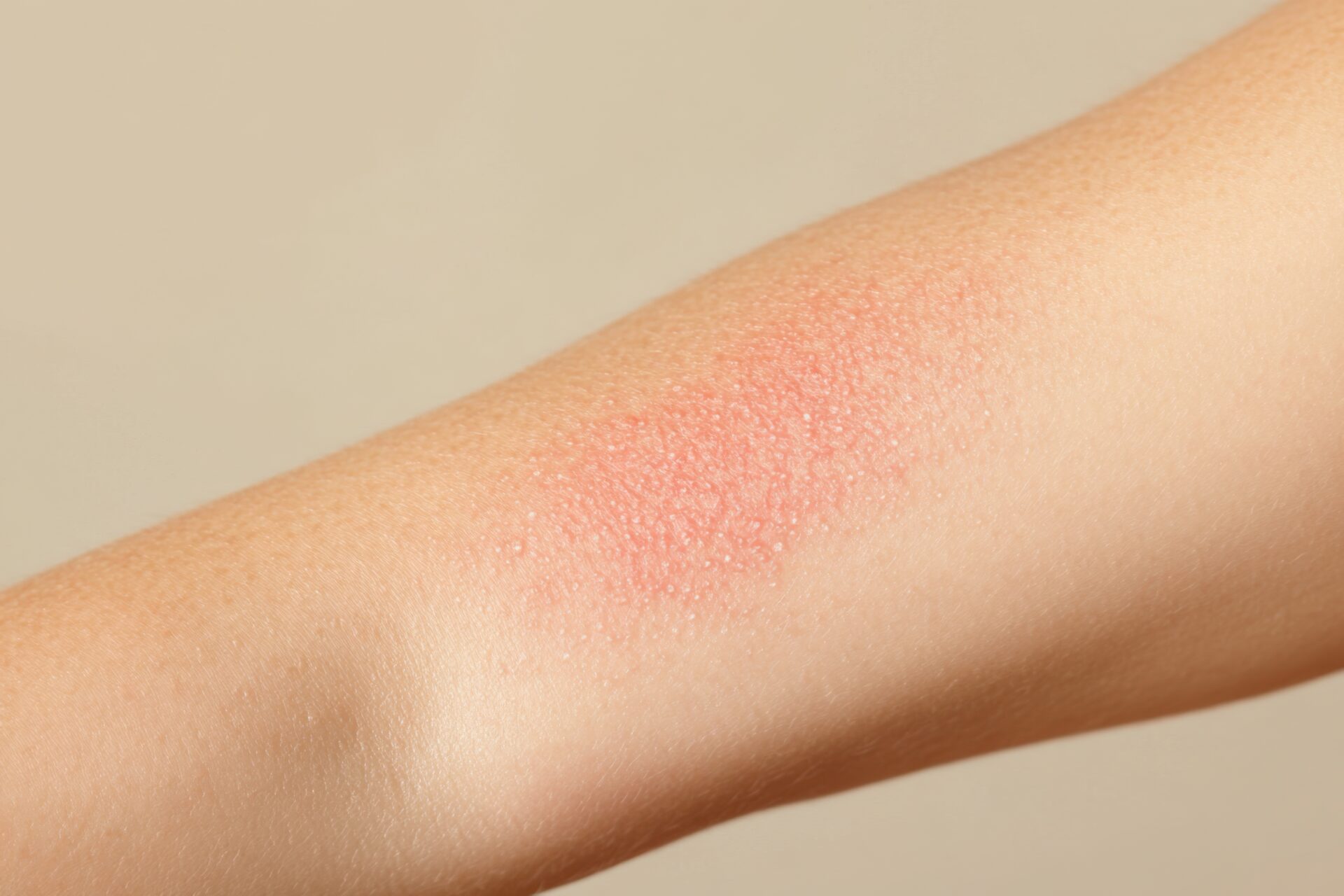 Close-up view of a skin allergy reaction on a person's arm showcasing redness and irritation rash after tattoo laser removal