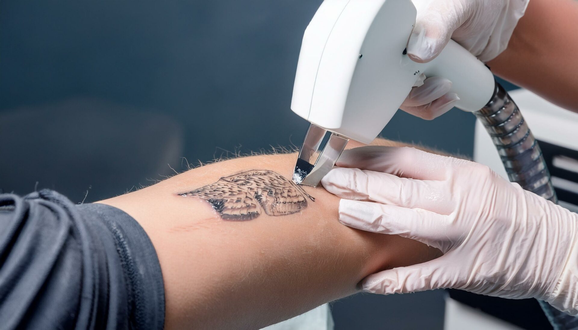 Laser Tattoo Removal lasering tattoo on skin